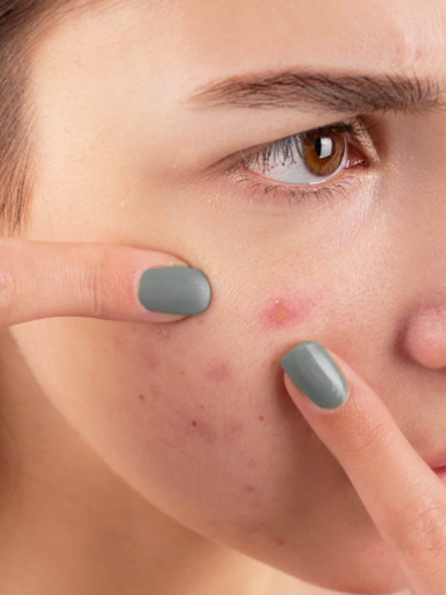 Tiny molecule delivered in skin could help get rid of acne, finds study