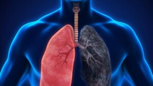 Chronic Obstructive Pulmonary Disease: जानें क्या है यह बीमारी जो मौत का बन सकती है कारण