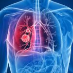 Lung Cancer: बिना डॉक्टर के फेफड़ों का कैंसर पहचानें, उंगलियों का उपयोग कर करें टेस्ट