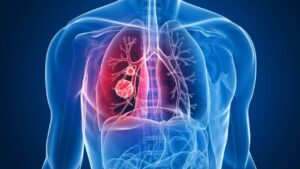 Lung Cancer: बिना डॉक्टर के फेफड़ों का कैंसर पहचानें, उंगलियों का उपयोग कर करें टेस्ट