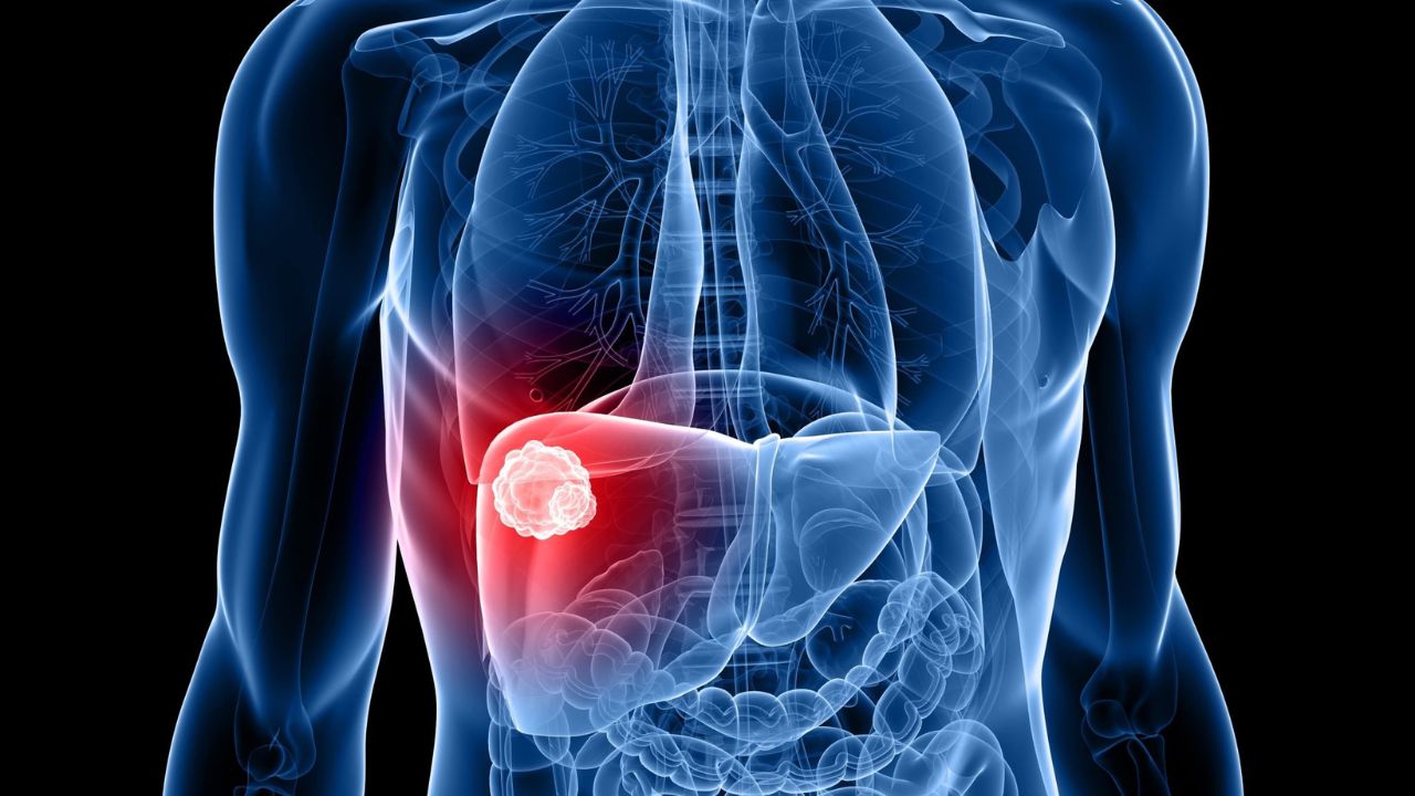 Liver Cancer: डायबिटीज और हाई कोलेस्ट्रॉल कैसे बढ़ाते हैं लीवर कैंसर, जानें रोकथाम के उपाय