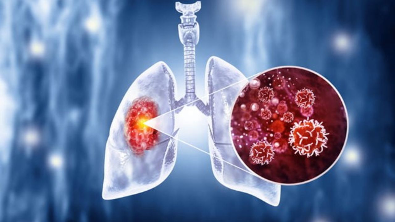 Lung Cancer: बिना डॉक्टर के फेफड़ों का कैंसर पहचानें, उंगलियों का उपयोग कर करें टेस्ट